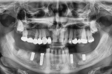 PREDNOSTI ZOBNEGA IMPLANTATA