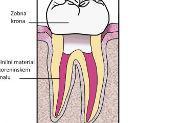 PONOVNO ENDODONTSKO ZDRAVLJENJE ZOB